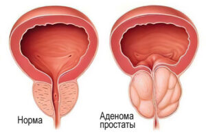 Аденома простаты