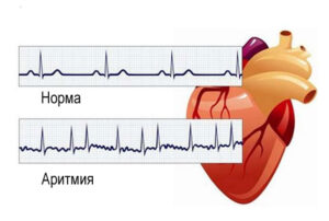 аритмия