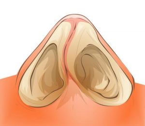 Хирургическая коррекции носовой перегородки и ноздрей: методы лечения